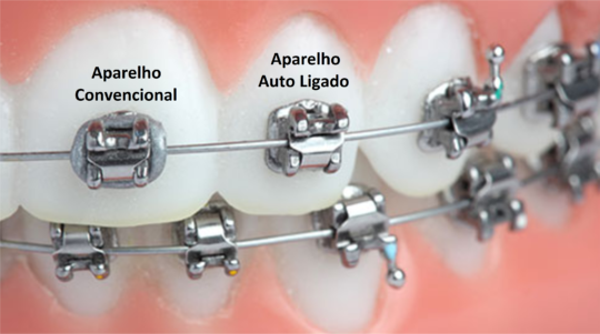 Aparellhos Autoligado