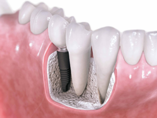 Implantes Dentários e Protocolos de Boca Toda<